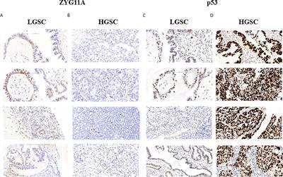 ZYG11A Is Expressed in Epithelial Ovarian Cancer and Correlates With Low Grade Disease